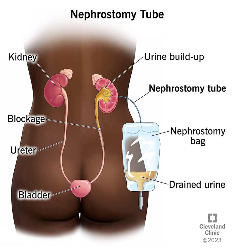 Nephrostomy tube in a urinary system.