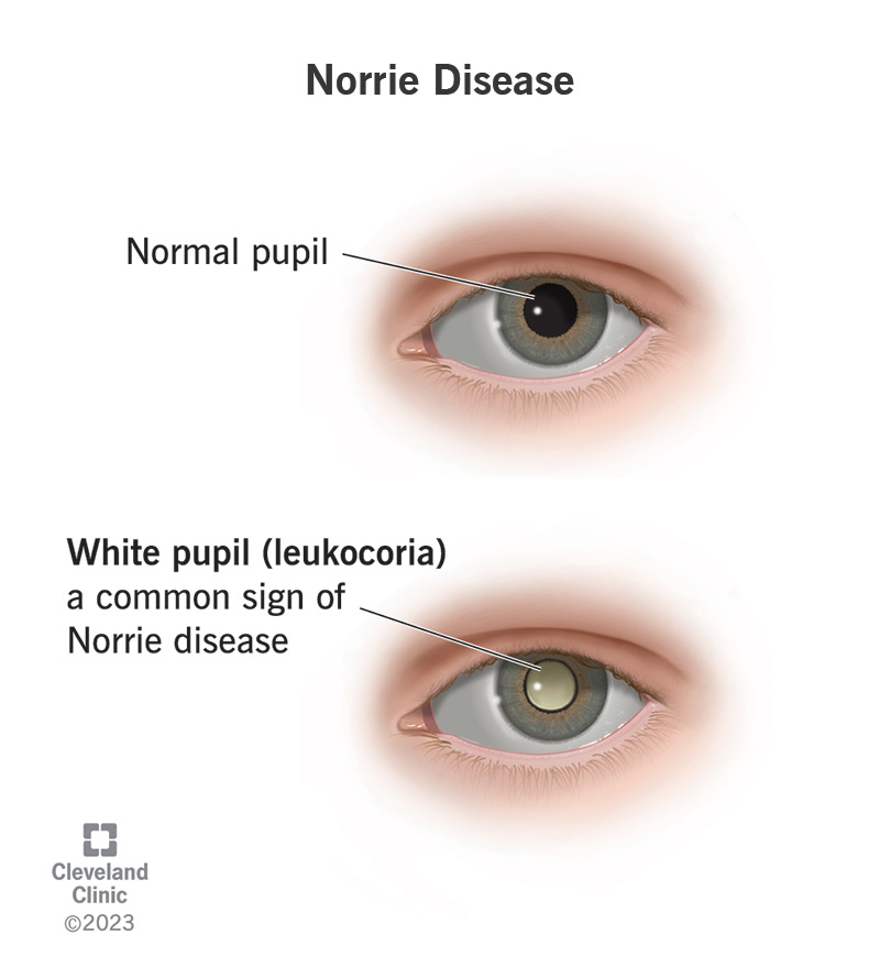 A white pupil (leukocoria) is a common sign of Norrie disease.