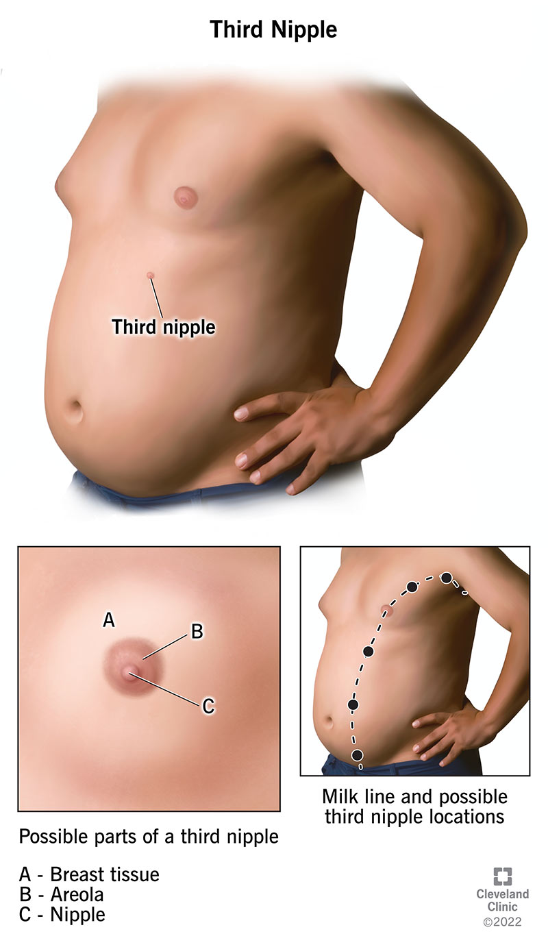 Third nipples are commonly found along the milk line. An areola and breast tissue may or may not surround a third nipple.