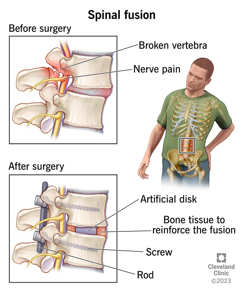 Spinal fusion reinforces your spine structure, taking pressure of your spinal cord or nerves that connect to it.