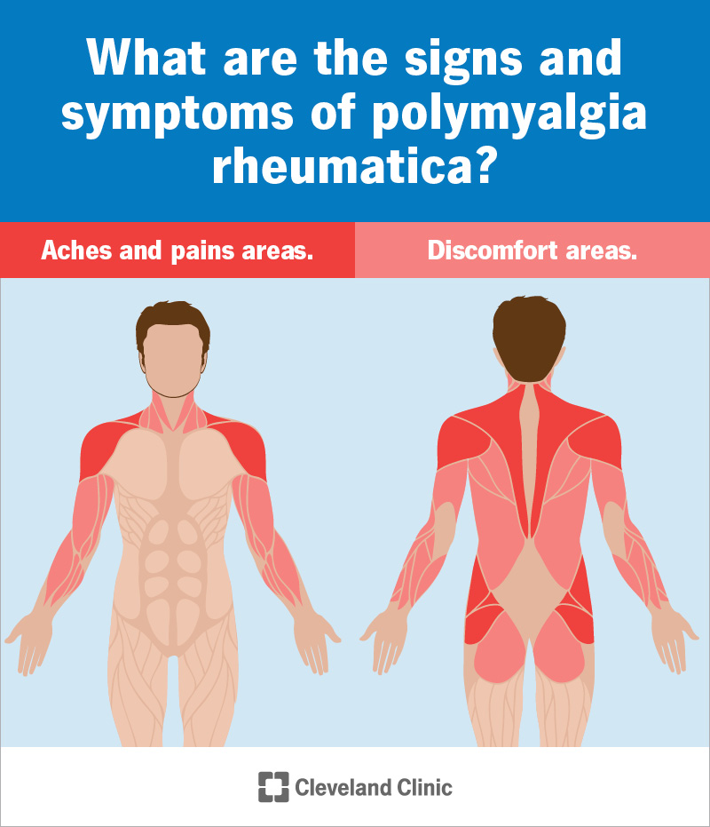 Areas of aches, pains and discomforts experienced with polymyalgia rheumatica.