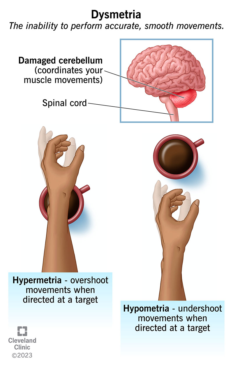 Dysmetria: a hand overshooting (hypermetria) and undershooting (hypometria) reaching for a coffee cup.