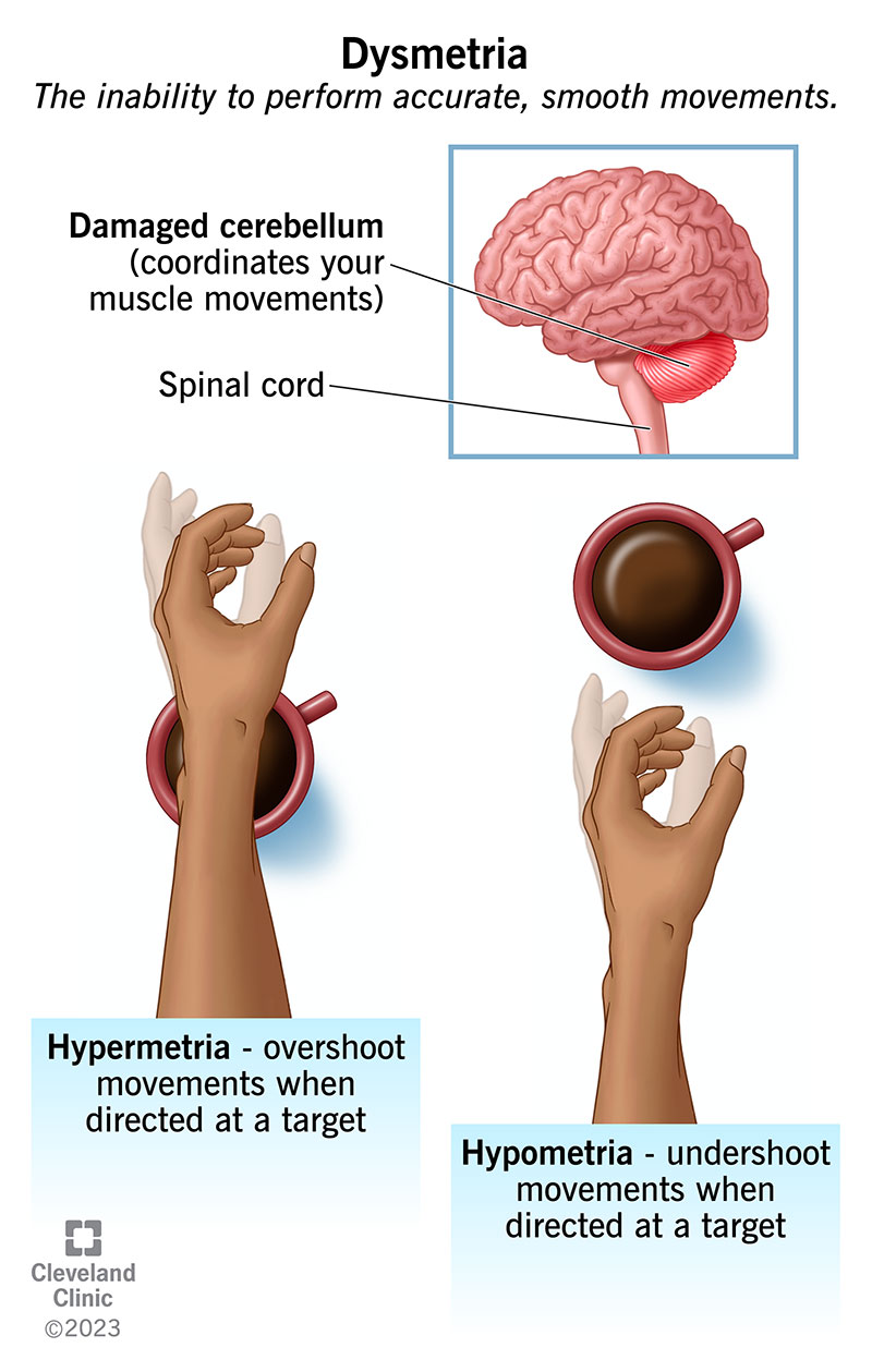 Dysmetria: What It Is, Types, Causes, Symptoms & Treatment