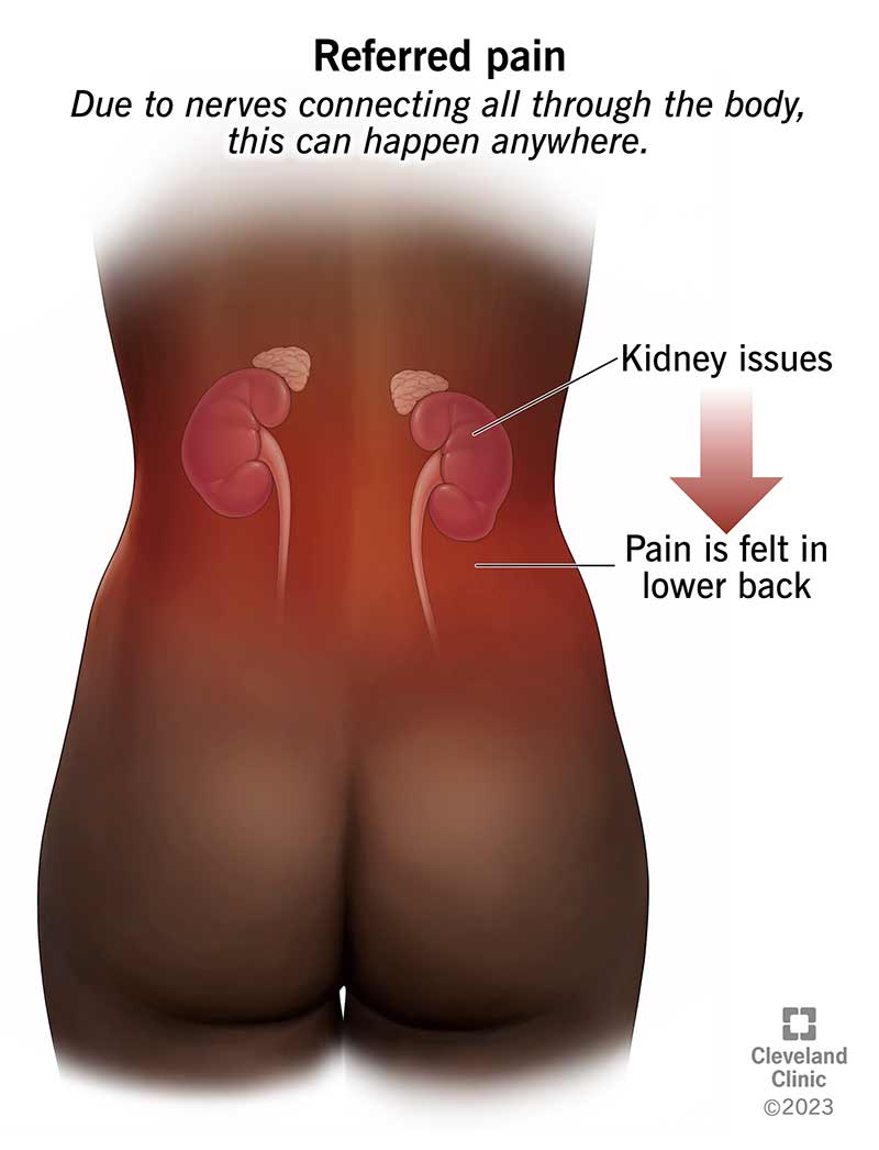 Diagram showing location of kidneys (mid-back), and where the referred pain is felt (lower back).