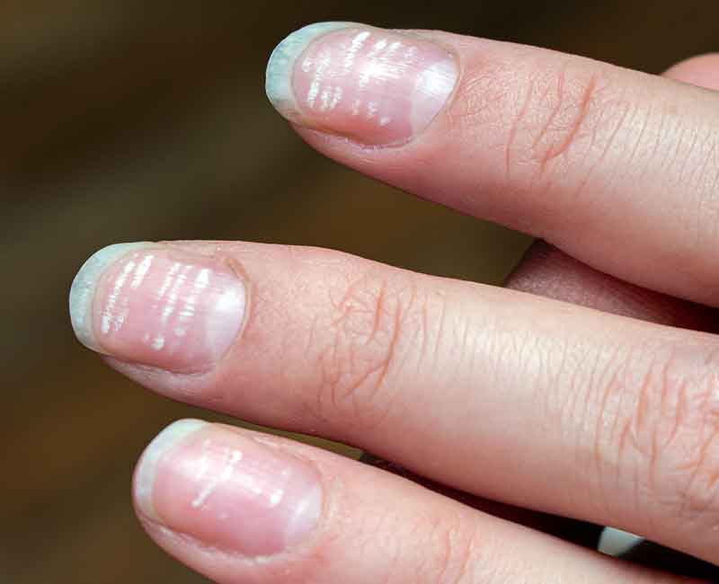 Three fingers with white spots on nails in horizontal lines.