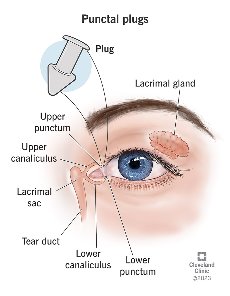 Punctal plugs can fit into a punctum, a tiny opening on the inside of your eyelid that drains tear fluid from your eyes.