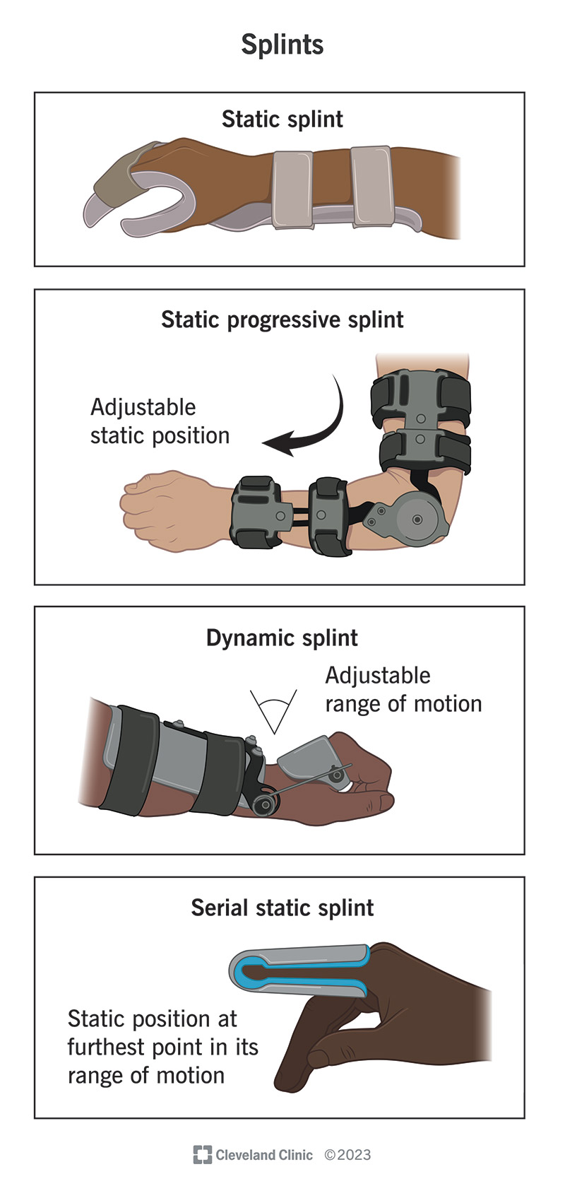 There are four common types of pre-made splints.