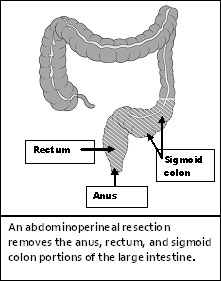 abdominoperineal resection