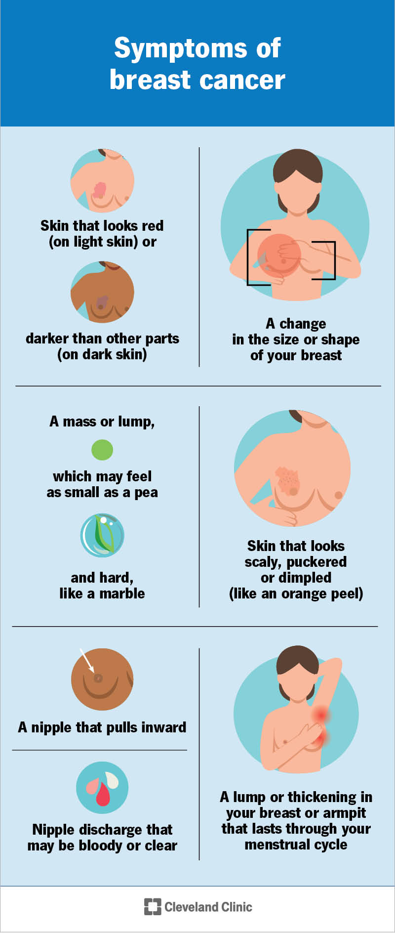 Breast cancer symptoms, including a new lump, changes in breast shape, and skin discoloration and irritation