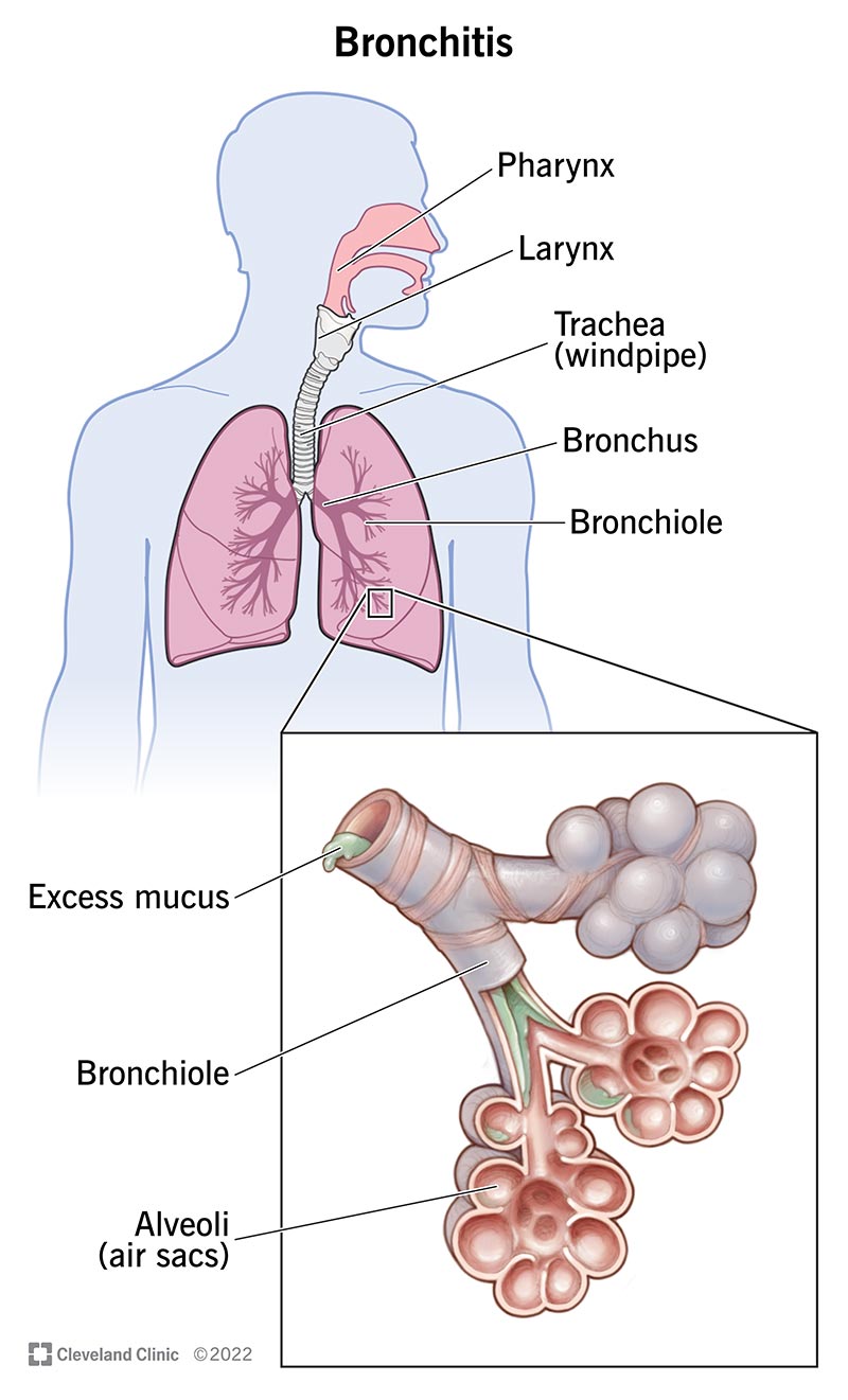 Image showing anatomy of your lungs. Your bronchi have excess mucus when you have bronchitis.