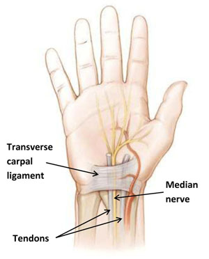Anatomy of a hand with carpal tunnel syndrome showing  the following: carpal tunnel, carpal bones, median nerve, flexor tendons, flexor carpi radialis tendon, flexor retinaculum, area of numbness