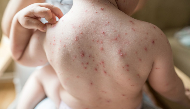 Chickenpox rash is spread across the back and arms of a child.