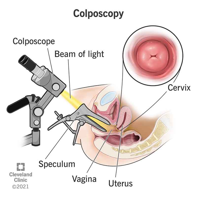 What not to do before colposcopy?
