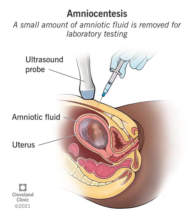 Healthcare provider removing amniotic fluid from a uterus with a needle.