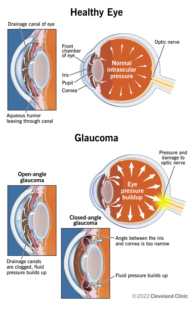 Aqueous humor flows through drainage canals in healthy eyes with healthy optic nerves, while optic nerves are damaged in eyes with glaucoma when fluids and pressures build up.