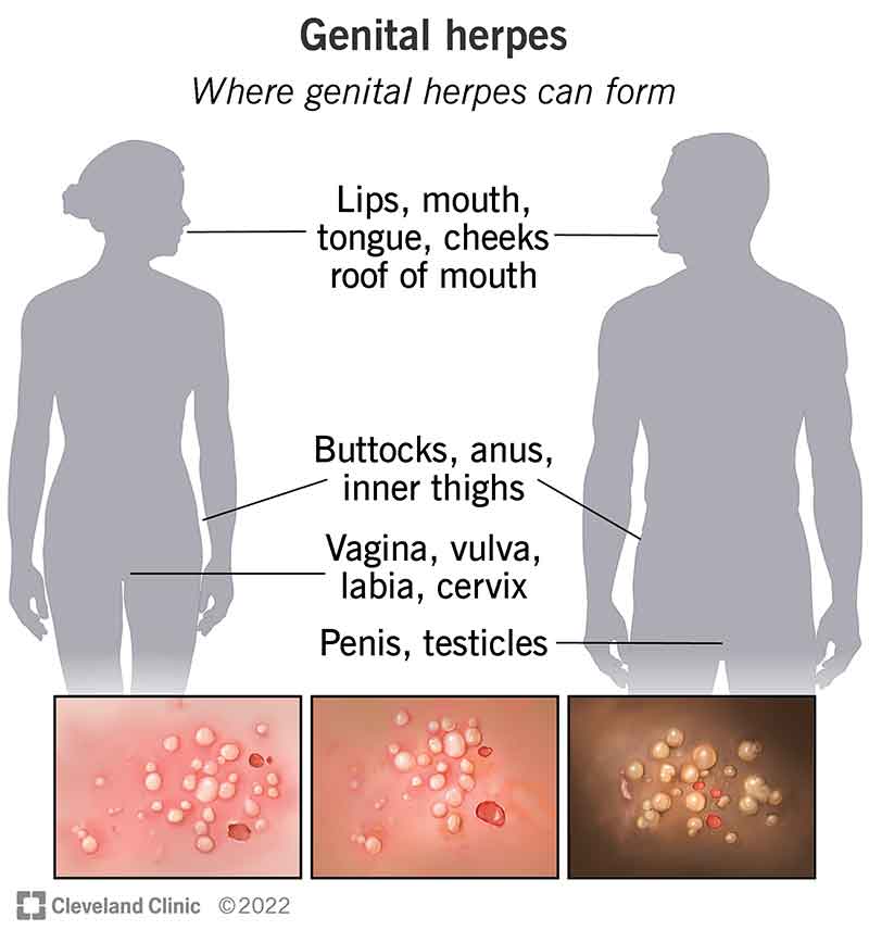 Outline of person assigned female at birth and a person assigned male at birth. Accompanying text highlights the body parts on each where genital herpes can form. Accompanying photos show genital herpes on skin.