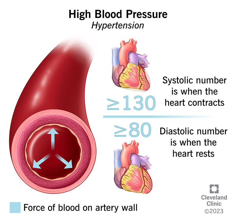 hypertension-causes-and-remedies