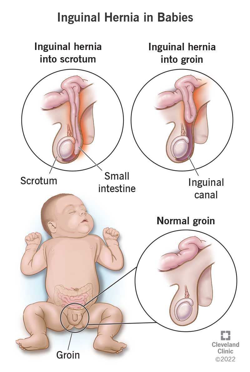 Inguinal hernia