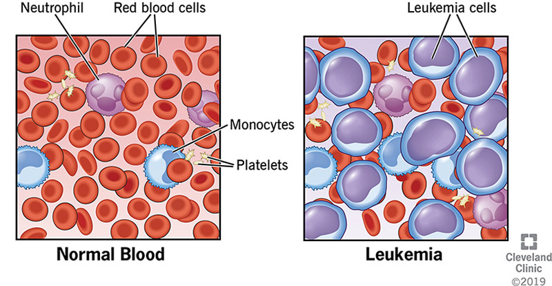 Normal blood contains red blood cells, white blood cells and platelets. Leukemia cells outnumber the normally seen healthy blood cells.