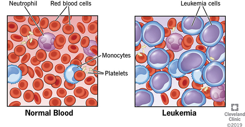 bone marrow loss symptoms