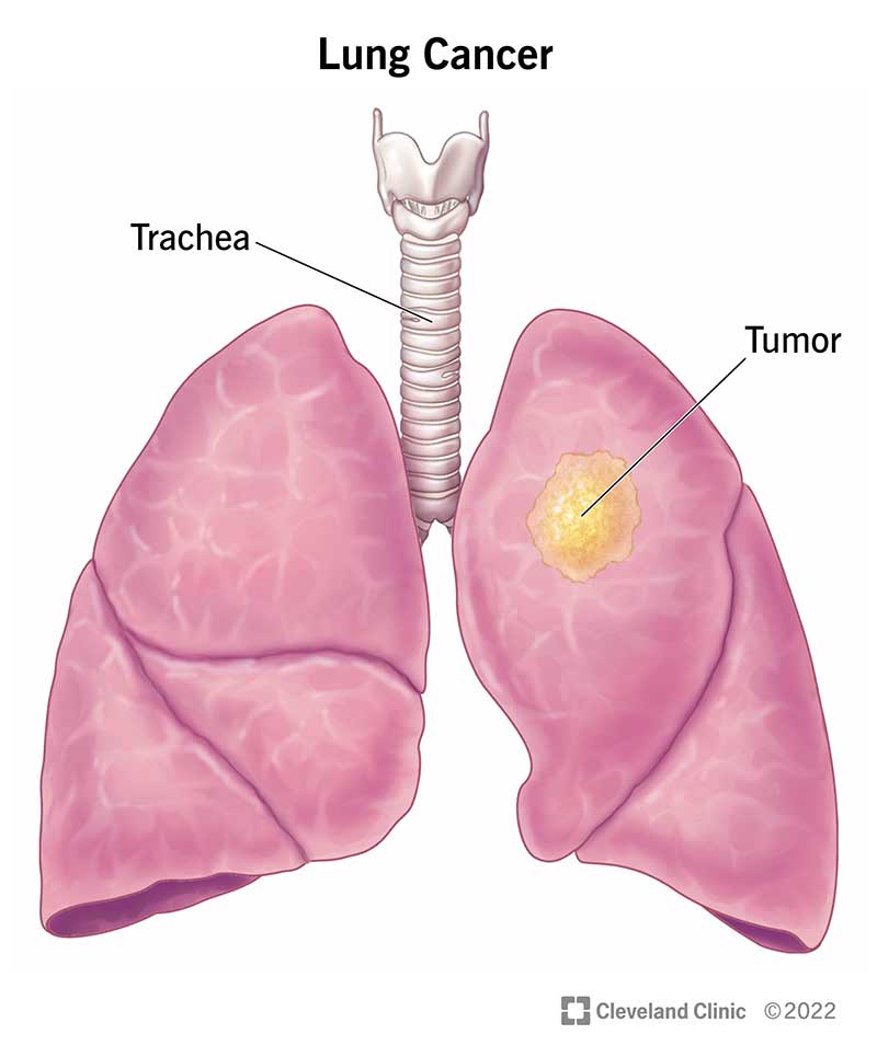 Illustration of trachea and lungs, showing large tumor in upper lobe of left lung.