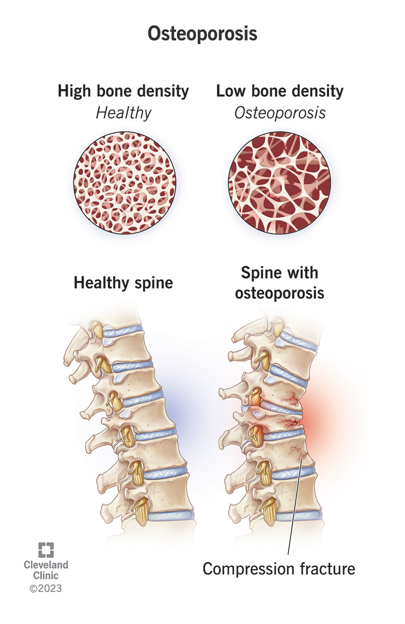 A healthy spine vs a spine with low bone density and compression fractures.