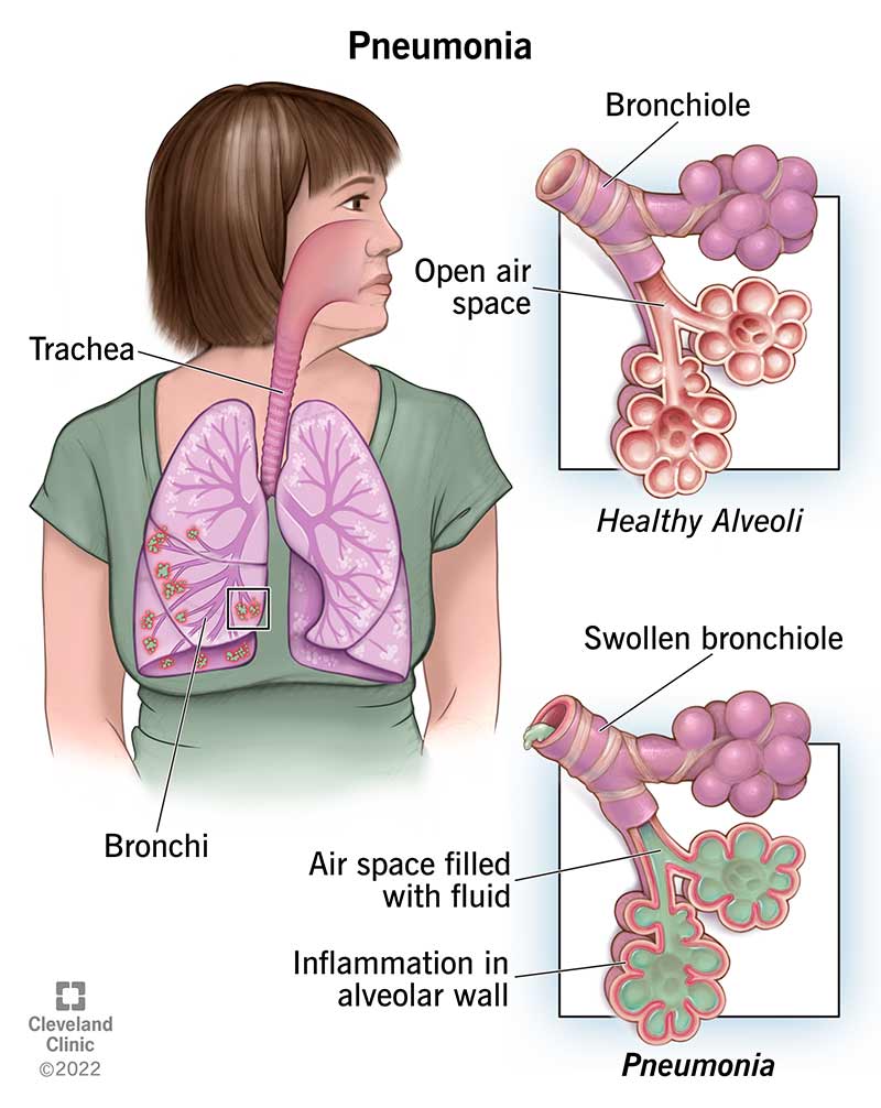 Illustration comparing healthy lungs to pneumonia. Lungs with pneumonia show inflamed, fluid-filled alveoli and airways.