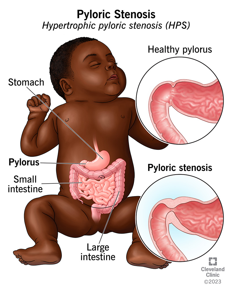 A healthy pylorus (muscular opening between stomach and small intestine) and a pyloric stenosis.
