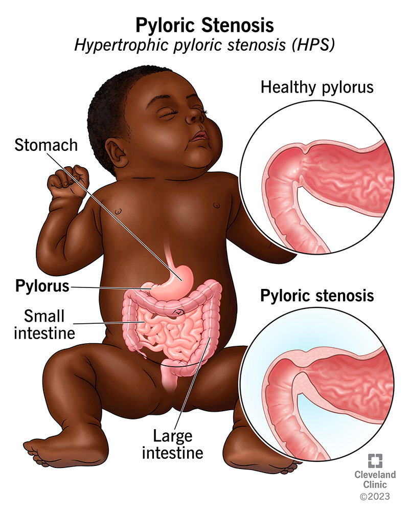 Pyloric Stenosis (HPS): Symptoms & Causes