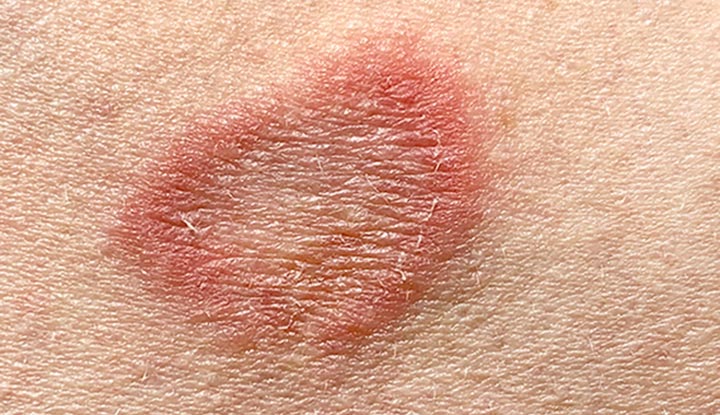 Ringworm (Tinea Corporis) on the skin.
