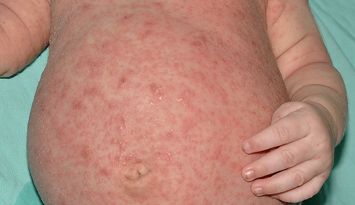 Scabies rash on the torso of an infant.