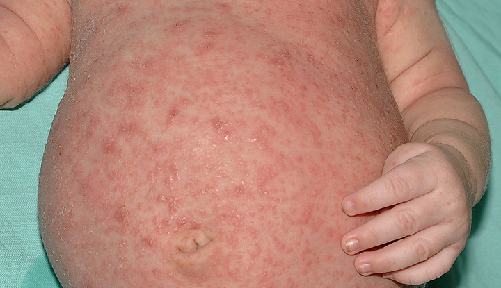 Scabies rash on the torso of an infant