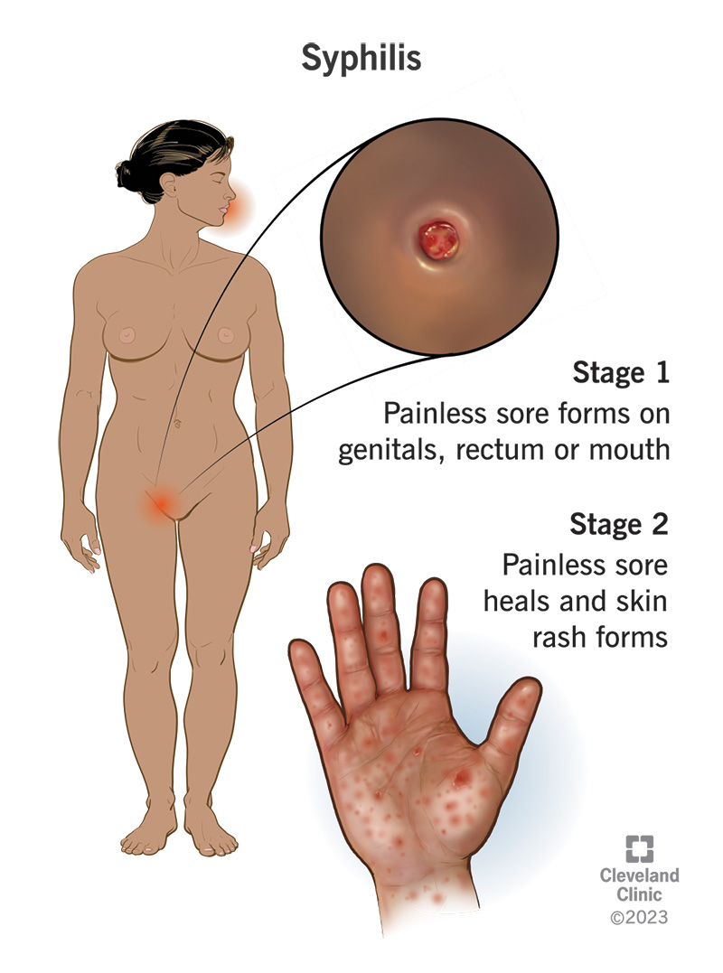 Syphilis Cause, Symptoms, Diagnosis, Treatment and Prevention