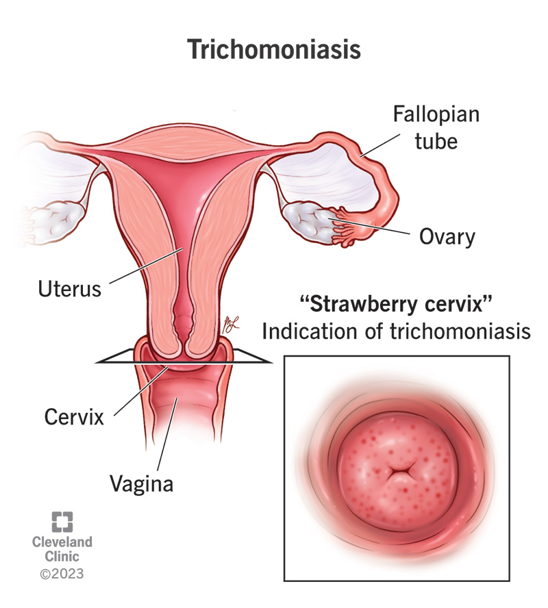 The female reproductive anatomy showing a cervix that resembles a strawberry, a common sign of trichomoniasis infection.