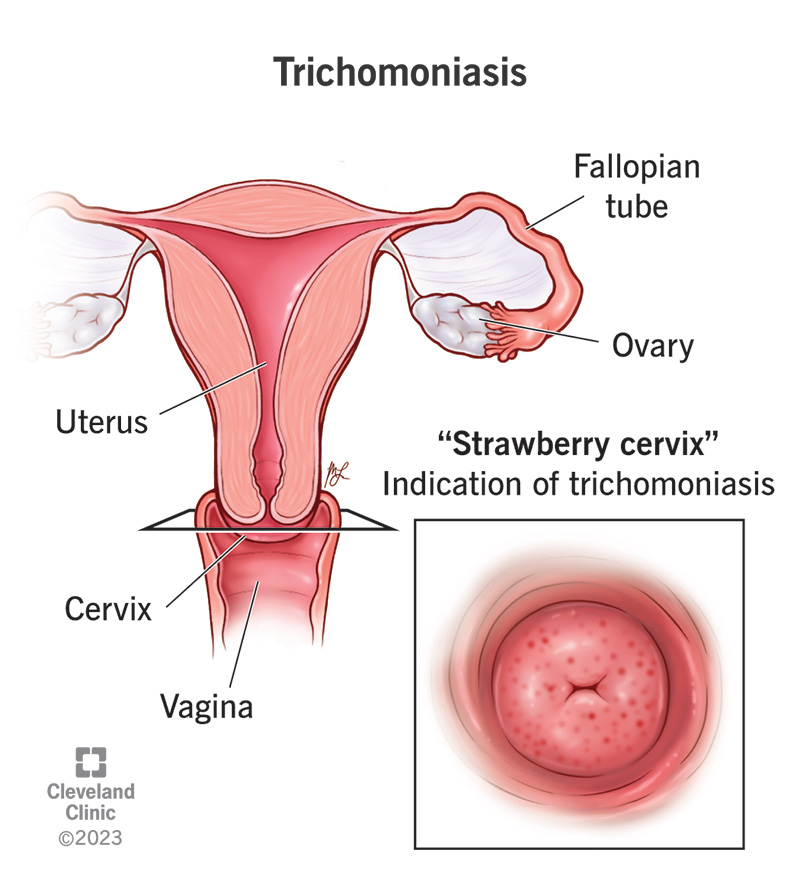 trichomoniasis discharge color in women