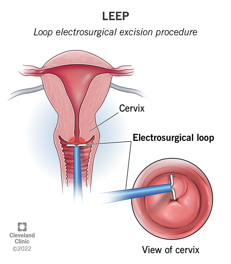 A frontal view of the cervix that shows the electrosurgical loop removing cells during a LEEP