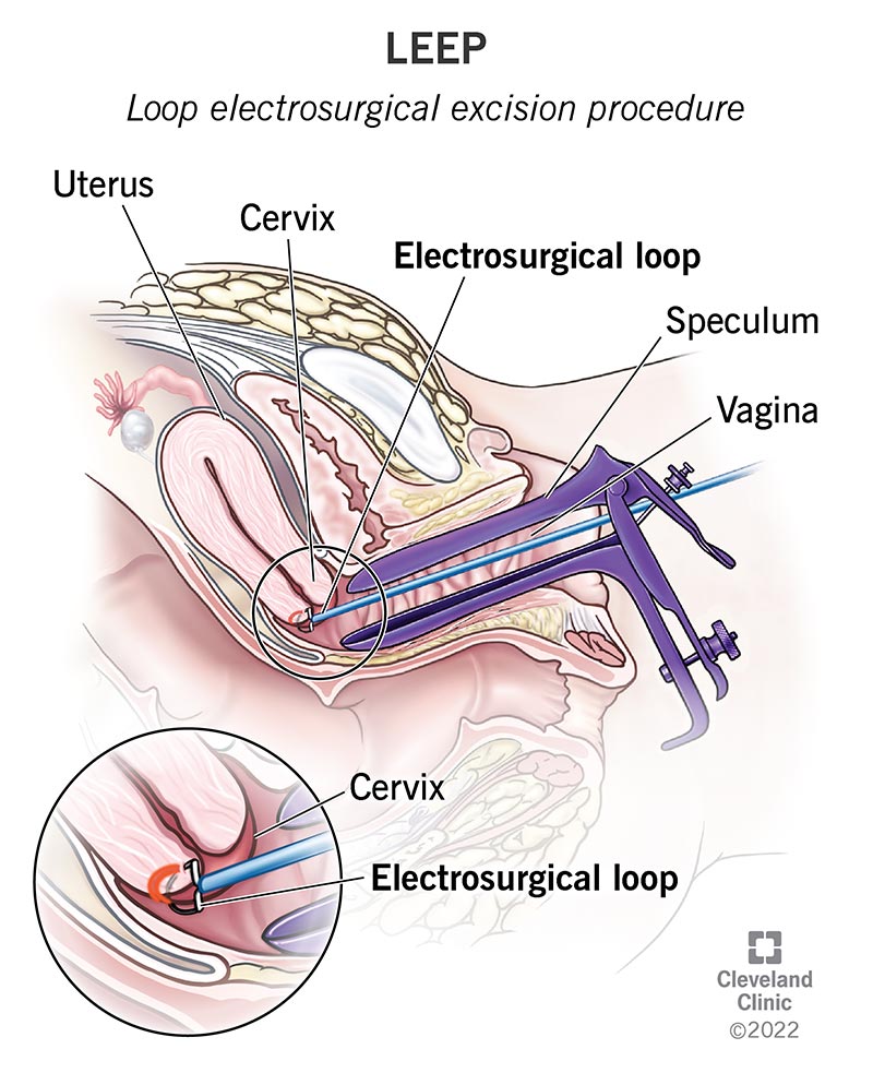 A speculum widens the vagina so that the LEEP wire can pass through the vaginal canal and reach the cervix.