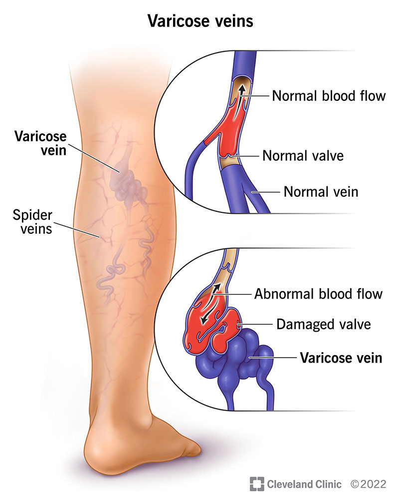 As varizes são vasos sanguíneos inchados e torcidos que se projetam sob a pele.