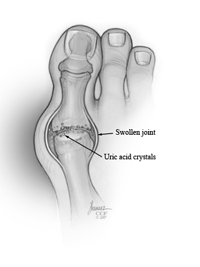 An illustration of gout in a big toe joint.