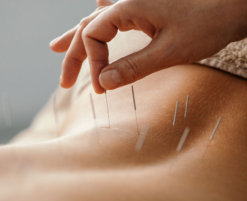 An acupuncturist inserts acupuncture needles into a person’s back.