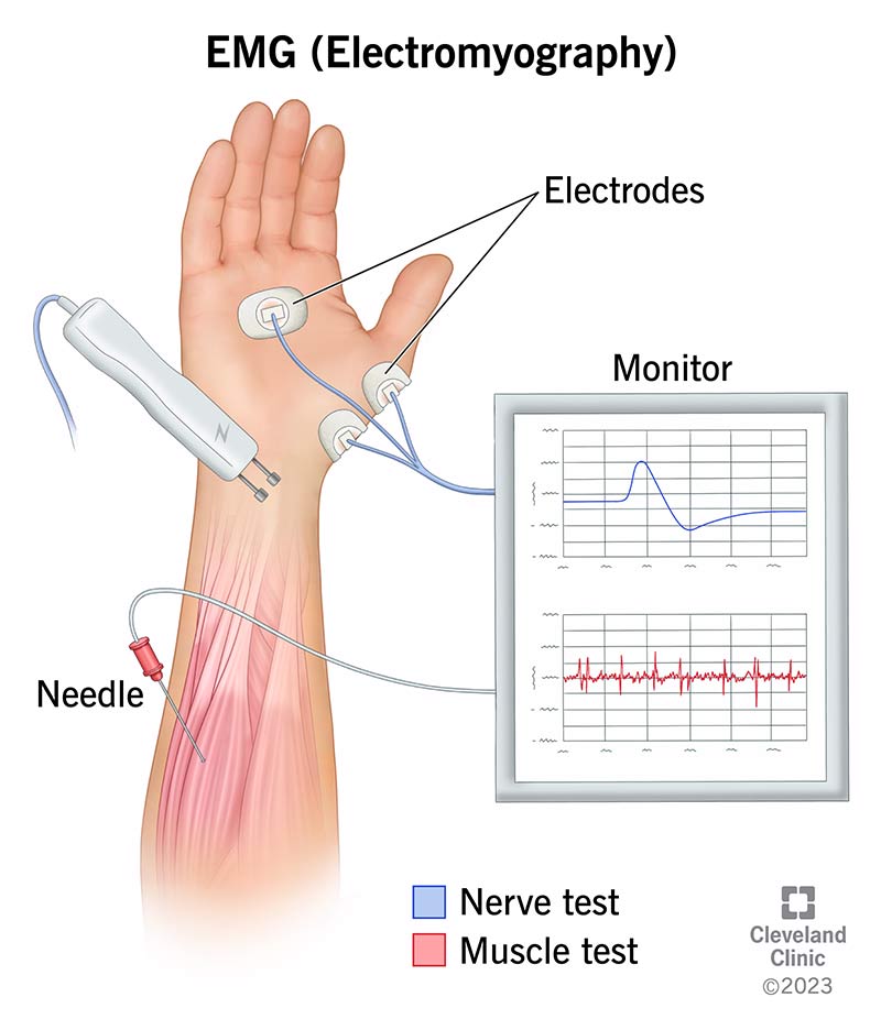 Illustration of arm with three electrodes attached to the skin and a needle in a muscle. It shows graphs of the muscle's electrical activity.