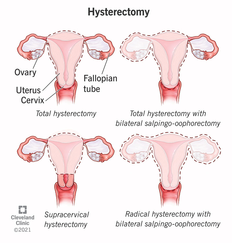 Different types of hysterectomy surgery.