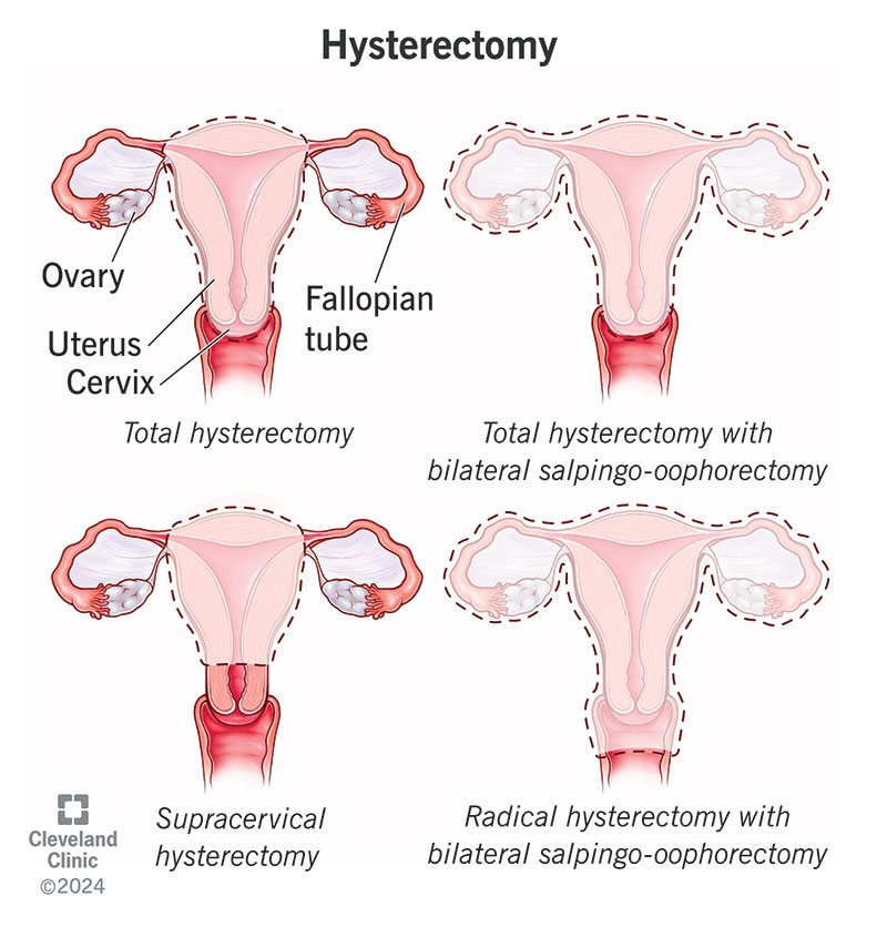 Different types of hysterectomy surgery