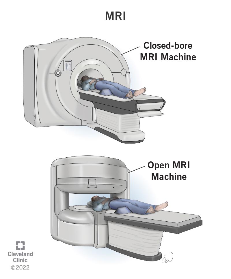 Medical illustration of two types of MRI machines. The closed bore MRI machine has a tube or tunnel opening for a person to lay in while images are taken. The open MRI machine has two large magnets above and below the person with open space in between.