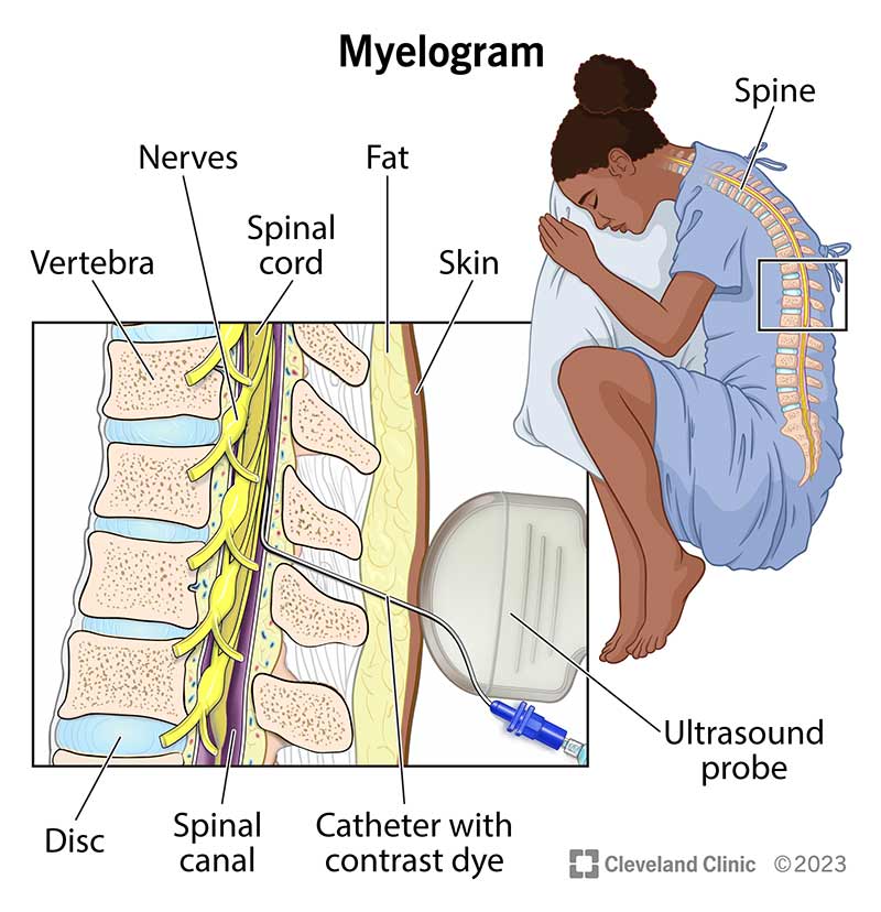 Person laying on their side to have a myelogram; cross section of spinal column.