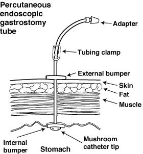 Peg Tube Percutaneous Endoscopic Gastrostomy