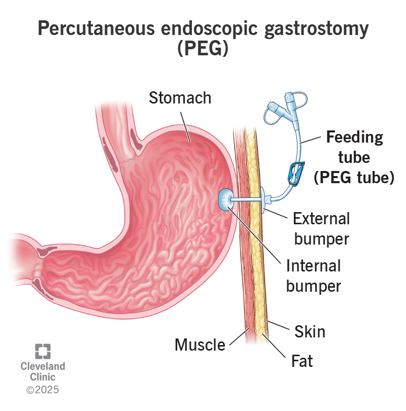 A percutaneous endoscopic gastrostomy (PEG) tube placement in the stomach.