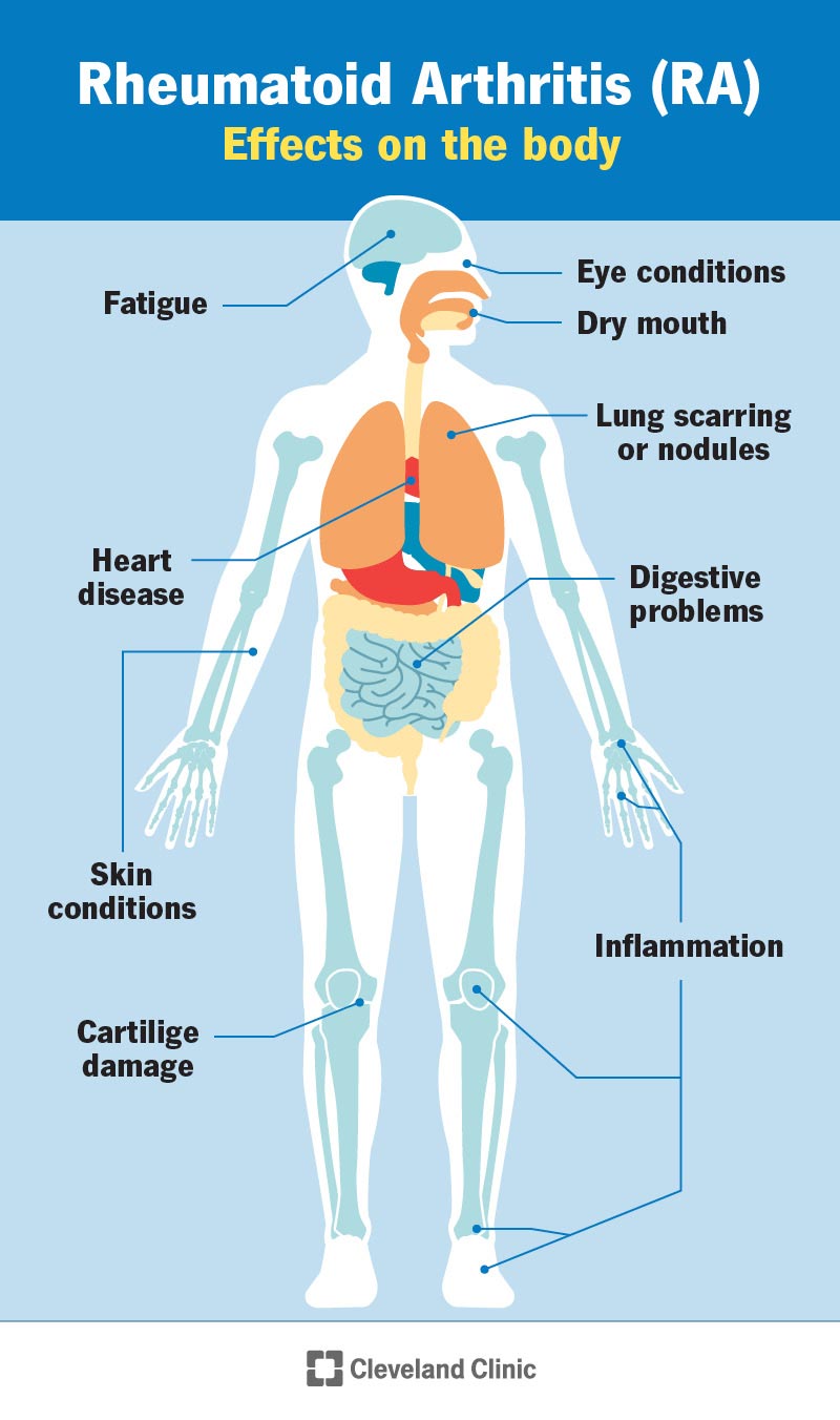 Rheumatoid Arthritis (RA) Causes, Symptoms & Treatment FAQs