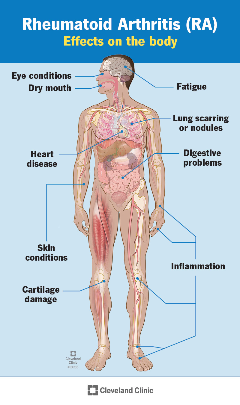 Types Of Arthritis & Tips To Manage Arthritis Symptoms