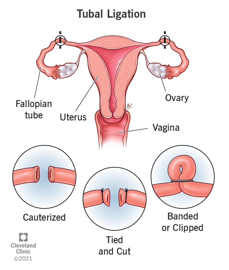 Common types of tubal ligations.